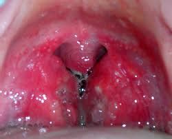 Tonsillitis is an infection of the tonsils that can cause that tissue in the back of the throat to become red, swollen, irritated, and painful. Tonsillitis Understood: Why does penicillin not work in ...