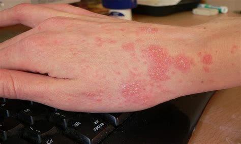 Scabies Rash Look Like And Causes10