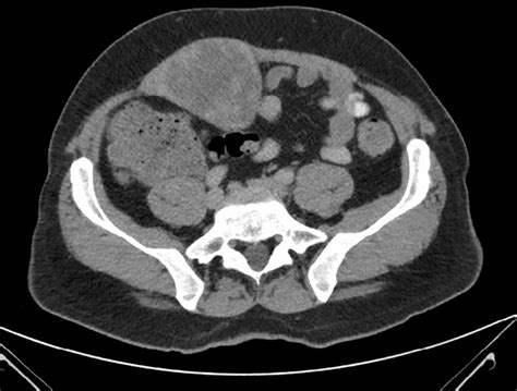 High Grade Myxofibrosarcoma Of The Abdominal Wall Bmj Case Reports