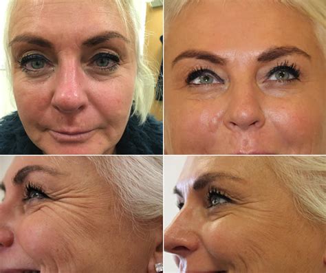 Wrinkles On Your Face And Forehead Lines Skin Clinic In Gerrards Cross