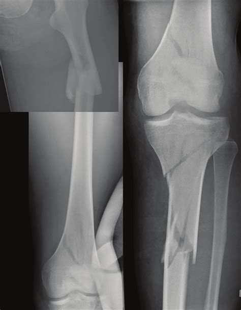 Diaphyseal And Intra Condylar Fractures In The Femur And Segmental
