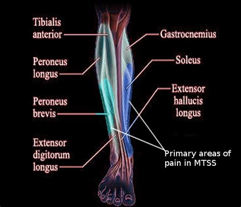 Figure Medial Tibial Stress Syndrome Image Courtesy S Bhimji Md