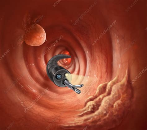 If any tests detect abnormalities in the colon, the person will likely need a colonoscopy to help identify the issue. Colonoscopy with Cancer and Polyp - Stock Image - C022 ...