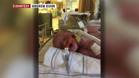 Baby Born Without Anus