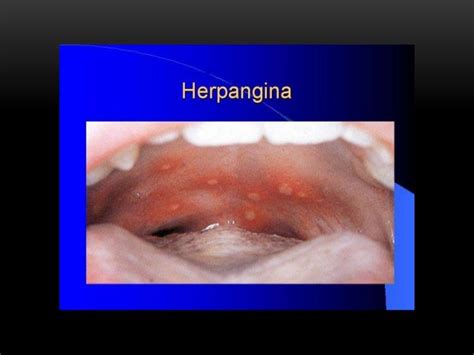 Sore Throat And Streptococcal Pharyngitis