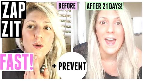 How To Zap Zits Fast Zits Zap Empowering Girls