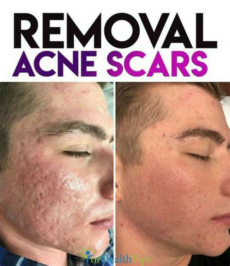 How To Cure Pimples Scars Fast And Effectively Heal Info
