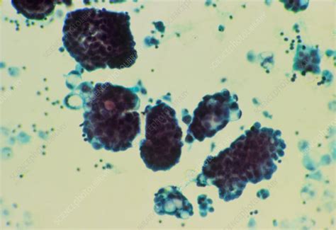 Lm Of Cancerous Glandular Cells In Ascitic Fluid Stock Image M132