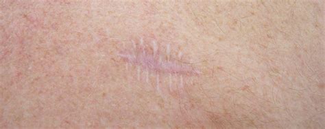 How To Reduce The Appearance Of Surgical Scars Skin Repair