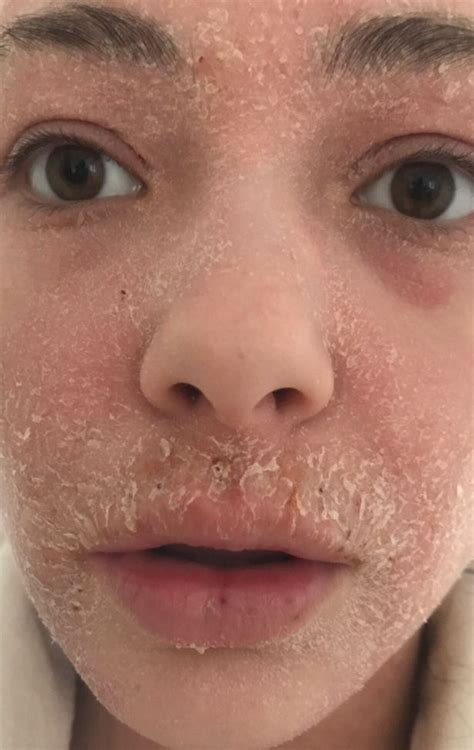 Woman Whose Eczema Was So Severe She Was Mistaken For Domestic Abuse