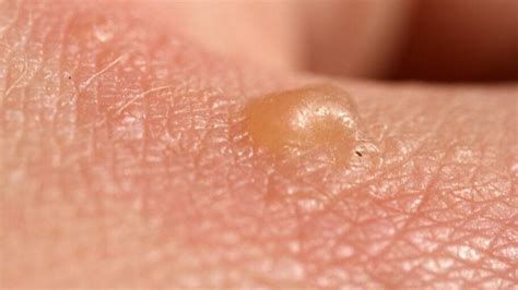 What Causes A Blister And Callus Angies List