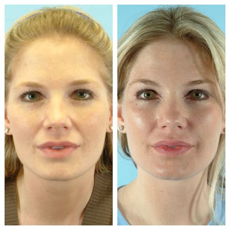 Photo Set Dermal Fillers Plastic Surgery Facial Wrinkles