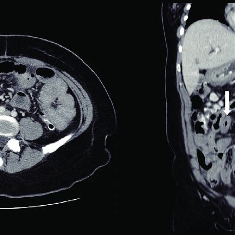 Abdominal Ct Small Bowel Thickening Arrow Is Evident In Both Axial