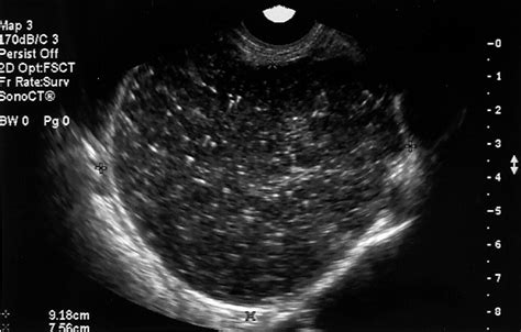 Cystadenocarcinoma Serous Cystadenocarcinoma Ovary Ultrasound Ovary