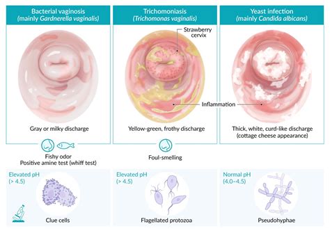 Trichomoniasis Discharge Color