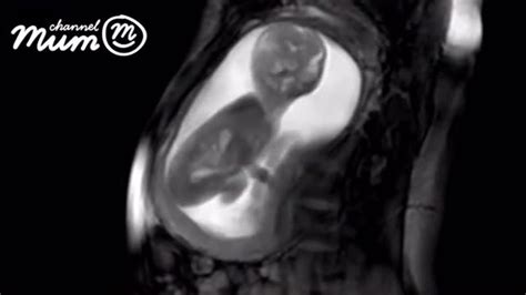 Incredible Footage Of Baby At 20 Weeks Mp4