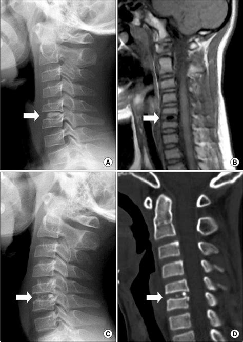 Cervical Intervertebral Disc