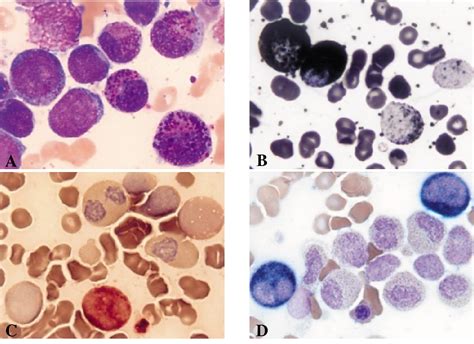 Figure 1 From Acute Myelomonocytic Leukemia With Abnormal Eosinophils