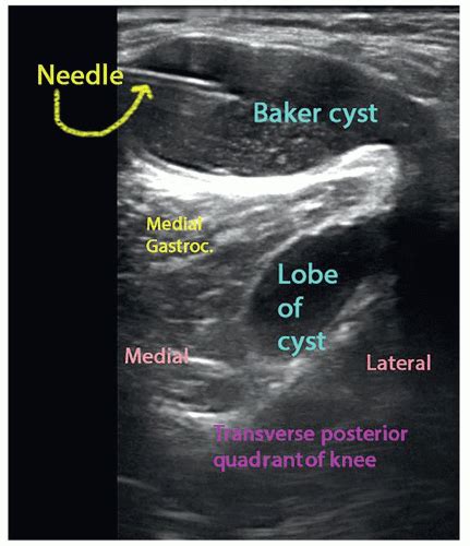 Ultrasound Guided Injection Technique For Baker Cyst Anesthesia Key