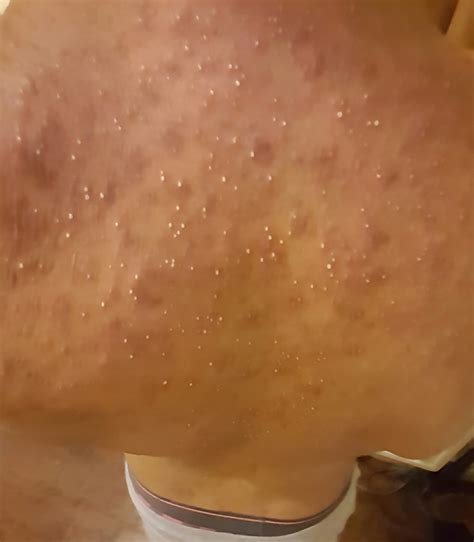 White Spots On Back After Waxing Backbodyneck Acne By
