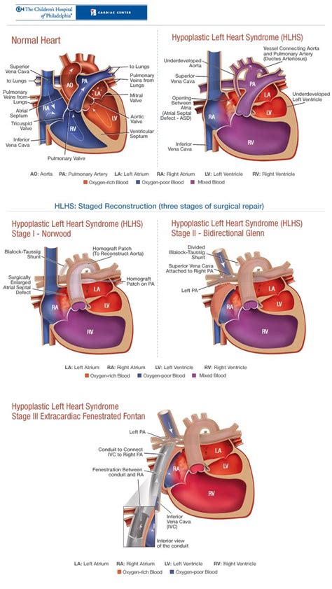 Hypoplastic Left Heart Syndrome Hlhs Pediatric Heart Cardiac
