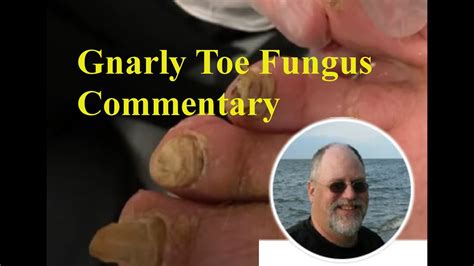 Toenail fungus is an infection that gets in through cracks in your nail or cuts in your skin. Ugly Feet Green Toes Commentary Toe Fungus - YouTube