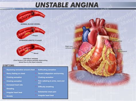 Unstable Angina Order