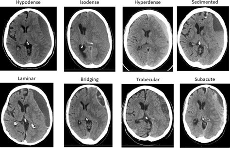 Overview Of All Eight Hematoma Subtypes Within The Extended