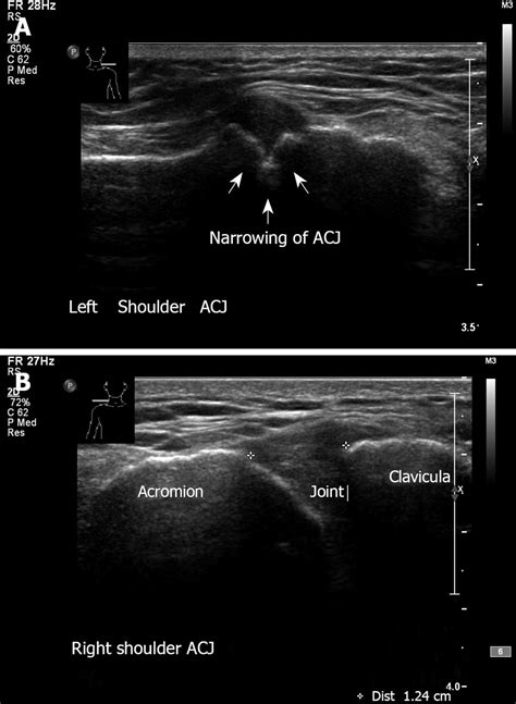 Ac Joint Ultrasound