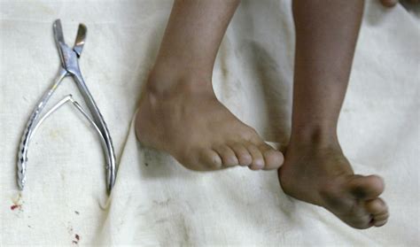 Benefits Of Circumcision Outweigh The Risks Top Us Pediatricians