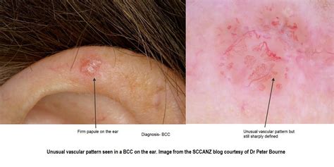 Dermoscopy Of Early Recurrent Basal Cell Carcinoma De