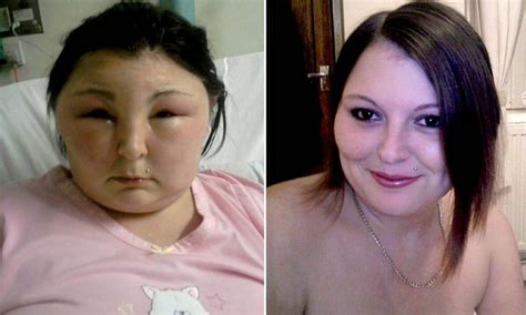 My Head Turned Into A Football Shocking Pictures Show Swollen Face Of Woman 25 After Allergic