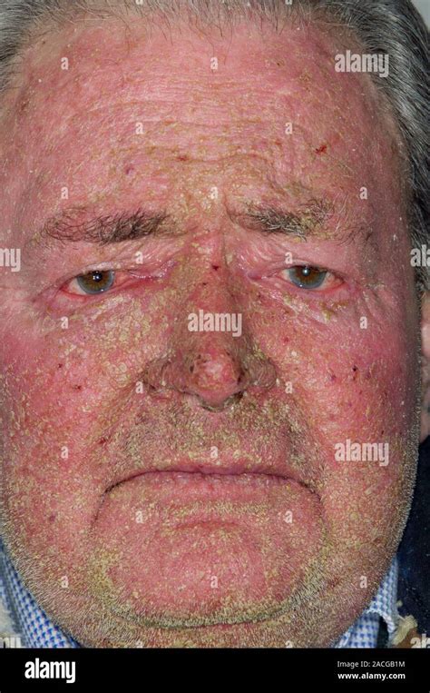 Face Of An 85 Year Old Male Patient Showing Exfoliative Dermatitis Ed