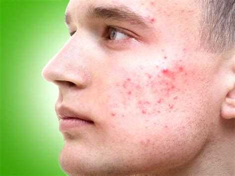 Pimples tend to have this uncanny ability to crop up all of a sudden that it's just unfair that they don't vanish easily. Flawless skin: Ways to treat pimples under the skin