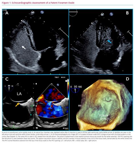 Echocardiographic Assessment Of A Patent Foramen Ovale Radcliffe