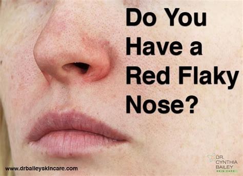 Do You Have A Red Flaky Nose In 2020 Dry Nose Skin Dry Skin On