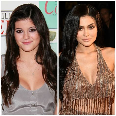 Kylie Jenner Antes E Depois Hot Sex Picture