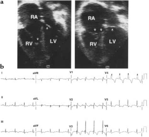 Echocardiogram And Ecg Characteristics Of Ebstein S Anomaly Bet