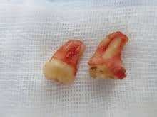 How do you pull out a tooth thats not loose. How to tell if a pulled tooth is permanent - Quora