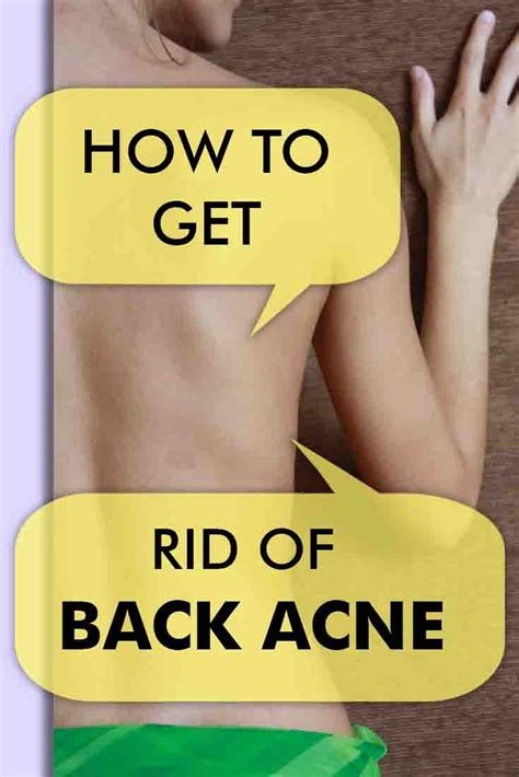 How To Get Rid Of Back Acne Home Remedies To Get Rid Of Bacne
