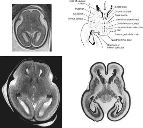 Sectional Anatomy Of The Fetal Brain Radiology Key