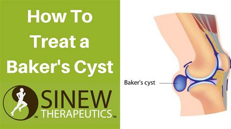 How To Treat A Bakers Cyst And Speed Recovery Youtube