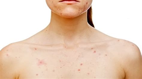 Chest Acne The Causes And The Remedies Health