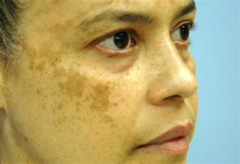 Three Natural Home Remedies For Melasma Pigmentation And Age Spots