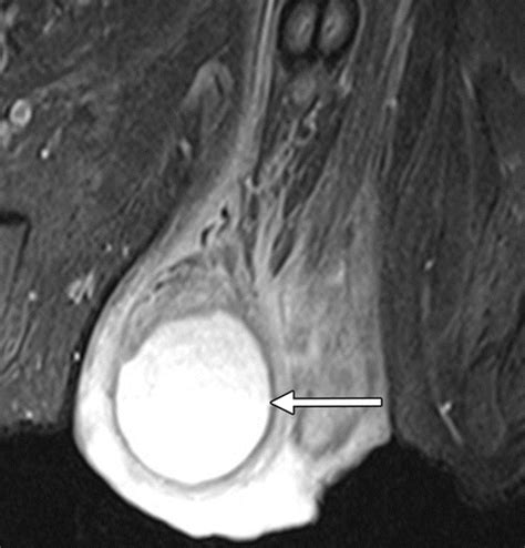 Spectrum Of Extratesticular And Testicular Pathologic Conditions At Scrotal Mr Imaging