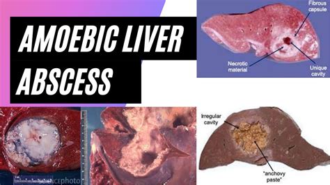 Amoebic Liver Abscess Morphology Youtube