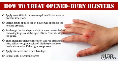 How To Treat Burns With Open Blisters