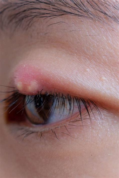 How To Get Rid Of A Stye Overnight