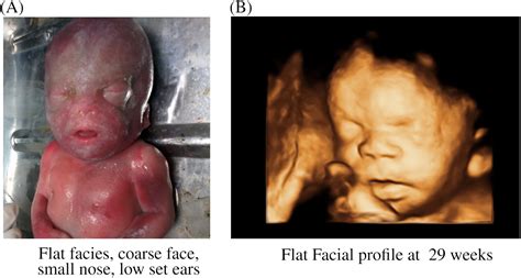 Pallisterkillian Syndrome Review Of Fetal Phenotype Thakur