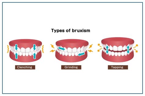 Best Bruxism Treatment At Medicover And Know More